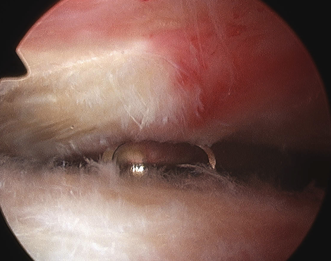 Arthroscopic Bursectomy